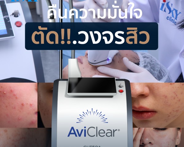 AviClear Laser ตัดวงจรสิว