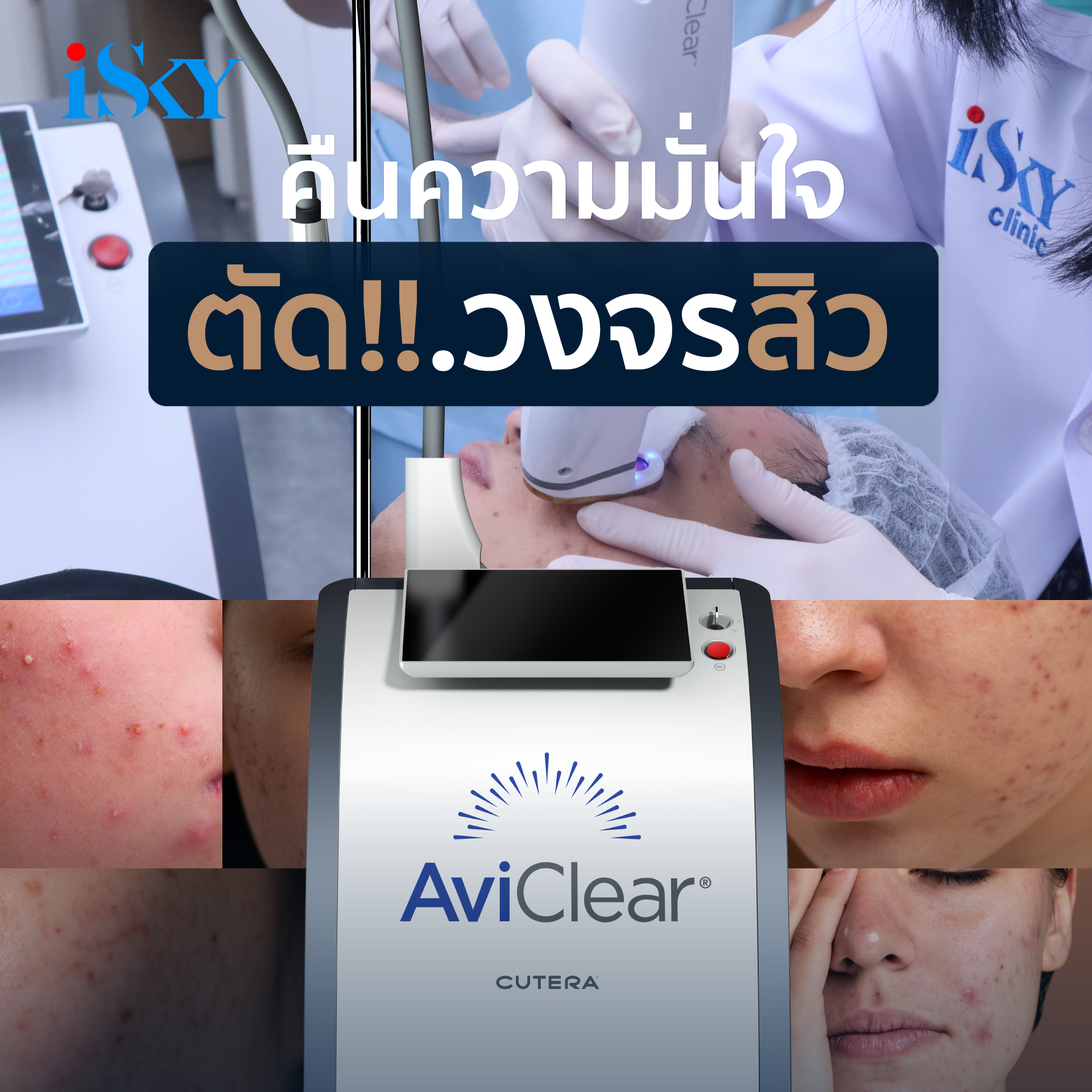 AviClear Laser ตัดวงจรสิว